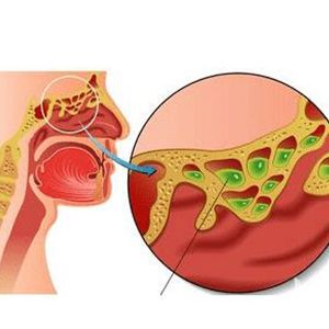 鼻窦炎