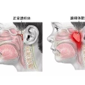 腺样体肥大