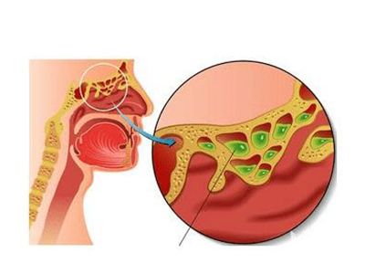 鼻窦炎