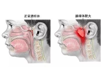 腺样体肥大